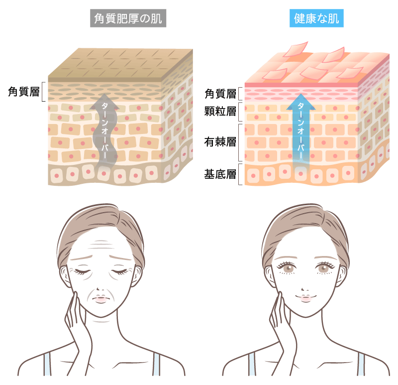 ターンオーバー